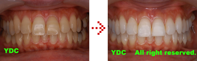 ホワイトニング前とホワイトニング後の写真