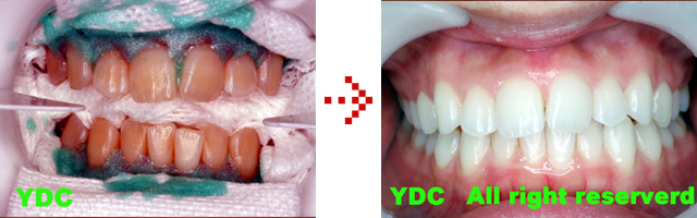 ホワイトニング前とホワイトニング後の写真