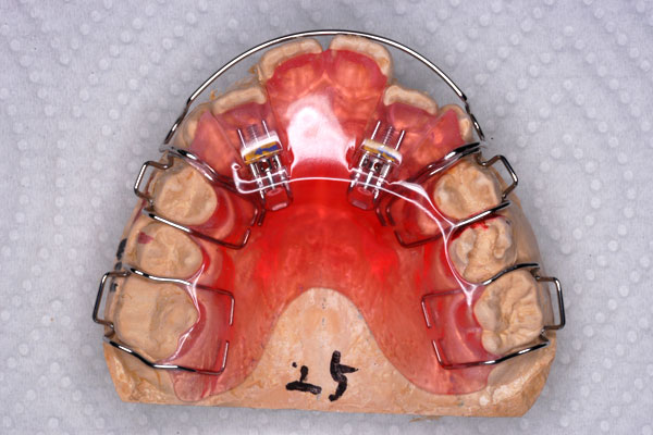 歯を前方に押し出す床矯正装置