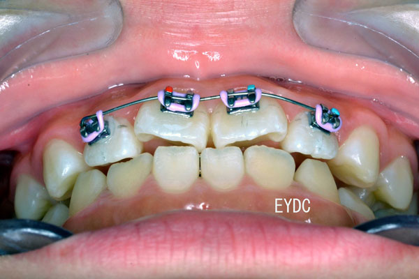 仕上げに前歯だけにブレースとワイヤーを装着