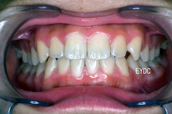 １期矯正の完成