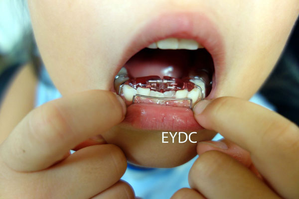 しょう（床）矯正装置を両手で上手にはめています