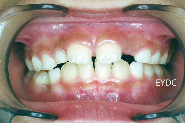 上の前歯がハの字型に生えて来ました