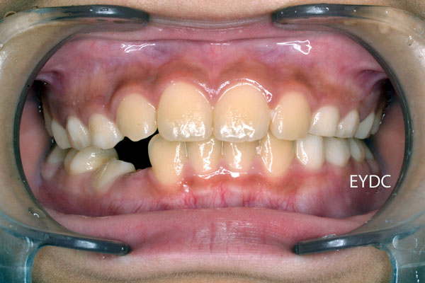 だんだん大人の歯が生えそろって来ました