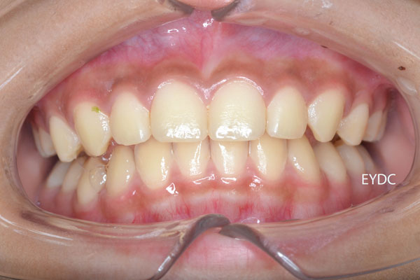 １１才７ヶ月。これで完成です。もう装置は付けなくてかまいません。