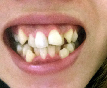 奥歯でしっかり噛んで、「イ～ッ」とくちびるを大きく広げてください。くれぐれも奥歯どうしで接触させてください。この程度の低い解像度でもかまいません