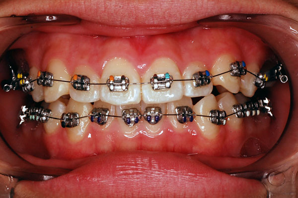 ギラギラした針金を見られることはありません！